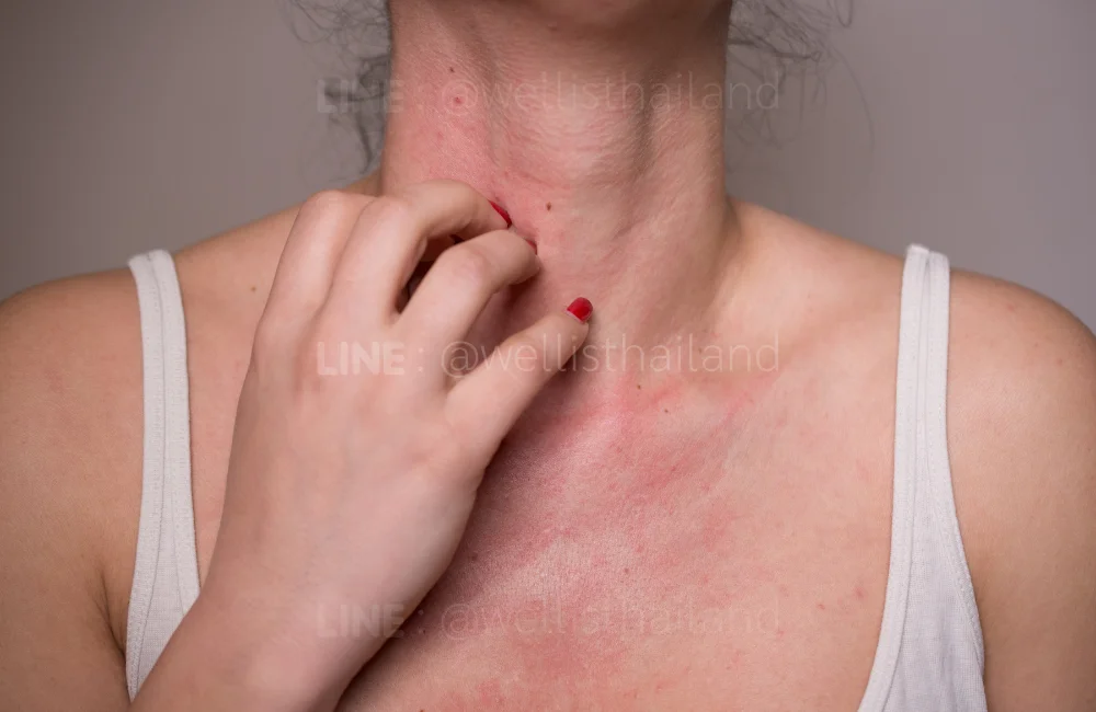 ประเภทของโรคภูมิแพ้ที่พบบ่อย