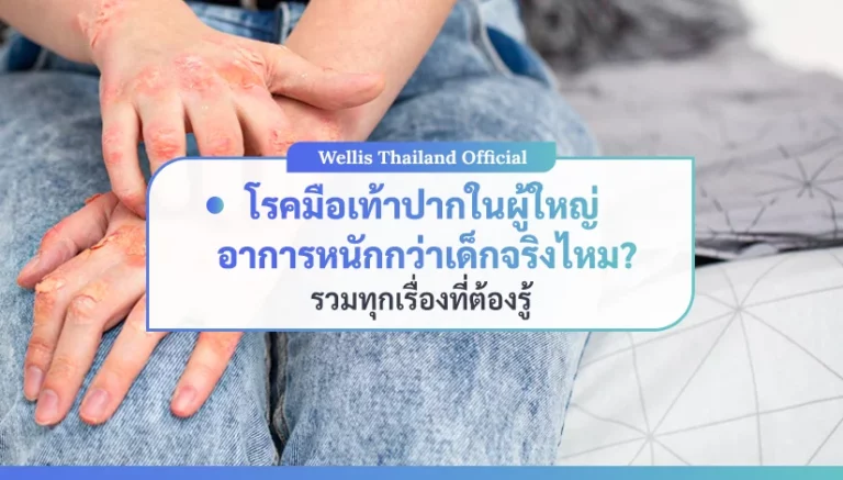 โรคมือเท้าปากในผู้ใหญ่ อาการหนักกว่าเด็กจริงไหม รวมทุกเรื่องที่ต้องรู้