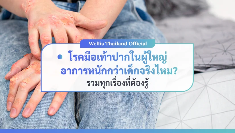 โรคมือเท้าปากในผู้ใหญ่ อาการหนักกว่าเด็กจริงไหม รวมทุกเรื่องที่ต้องรู้